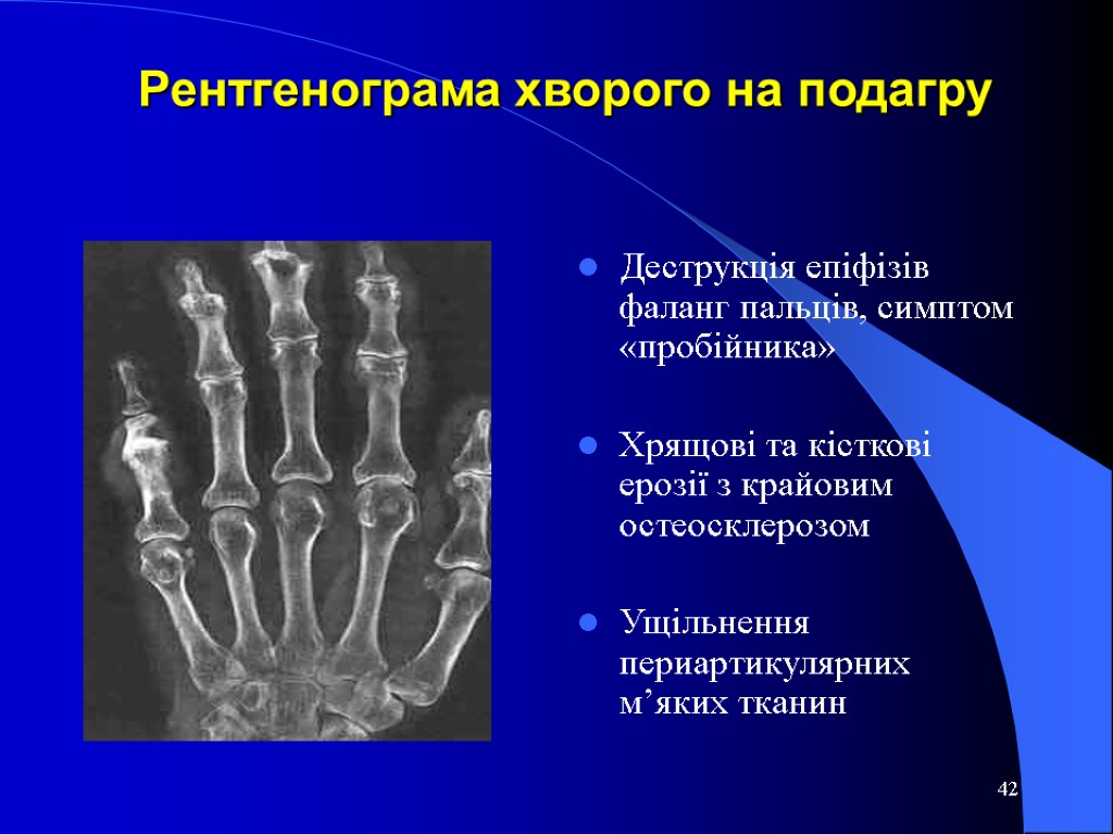 42 Рентгенограма хворого на подагру Деструкція епіфізів фаланг пальців, симптом «пробійника» Хрящові та кісткові